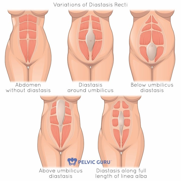 5 variations of diastasis recti